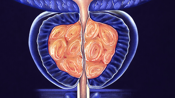 Prostat kanserinden 6 basit yöntemle korunun